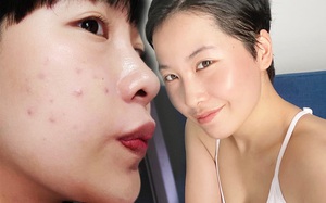 6 tháng trị mụn viêm với toàn đồ skincare dưới 400K, cô nàng này nhận ra: Đồ hi-end không phải lúc nào cũng thần thánh