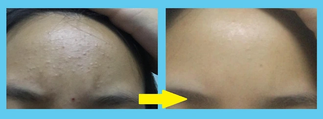 Vùng trán đầy mụn ẩn của cô bạn này đã mịn mướt trở lại nhờ bộ skincare cơ bản, món nào cũng chỉ loanh quanh 200-300k - Ảnh 2.