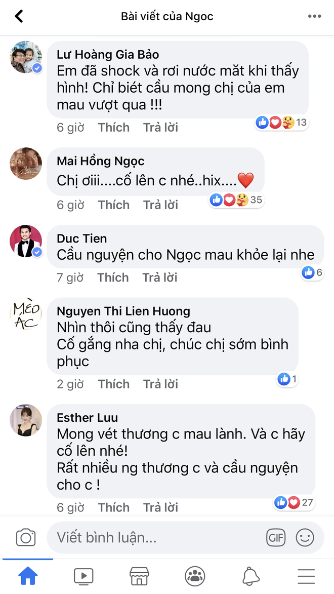 Ca sĩ Hồng Ngọc hé lộ ảnh cận vết bỏng nặng trên mặt, dàn nghệ sĩ Vbiz chạnh lòng rơi nước mắt - Ảnh 5.