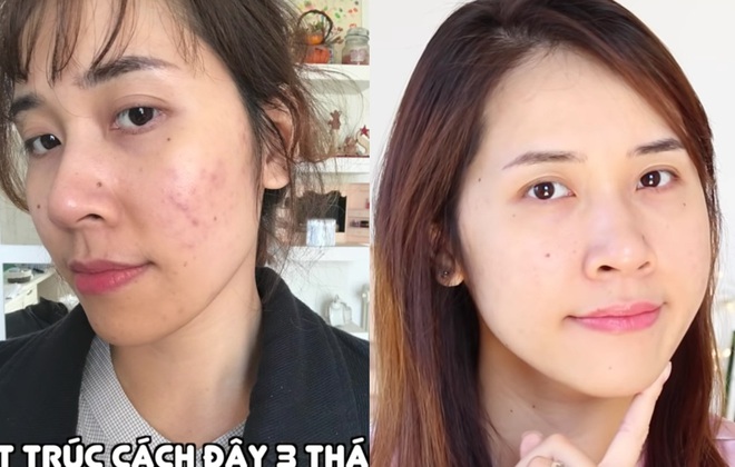 3 sản phẩm skincare thực sự cứu các beauty blogger khỏi cảnh thâm mụn, kiểu gì bạn cũng nhặt được ít nhất một món thật xịn - Ảnh 7.