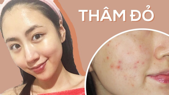 3 sản phẩm skincare thực sự cứu các beauty blogger khỏi cảnh thâm mụn, kiểu gì bạn cũng nhặt được ít nhất một món thật xịn - Ảnh 4.