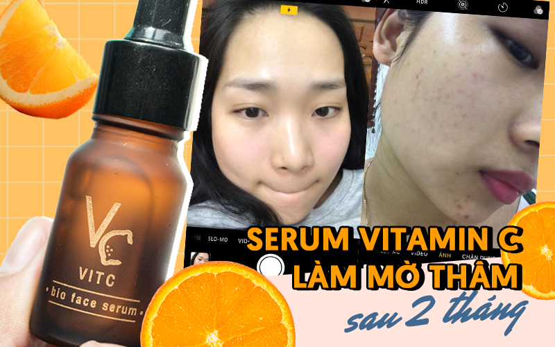 Từ chỗ thâm mụn tùm lum, làn da của tôi đã lột xác sáng mịn, căng bóng nhờ quy trình hợp lý, đặc biệt là loại serum Vitamin C bình dân của Thái Lan
