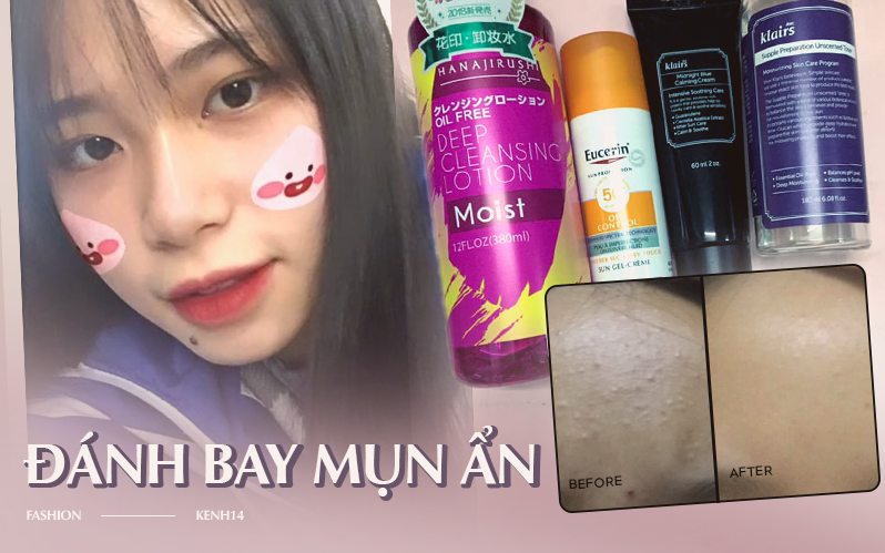 Vùng trán đầy mụn ẩn của cô bạn này đã mịn mướt trở lại nhờ bộ skincare cơ bản, món nào cũng chỉ loanh quanh 200-300k