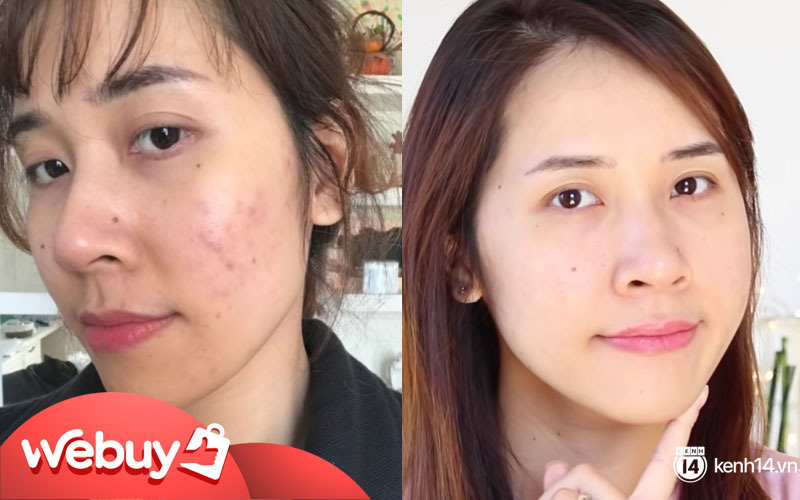 3 sản phẩm skincare thực sự cứu các beauty blogger khỏi cảnh thâm mụn, kiểu gì bạn cũng nhặt được ít nhất một món thật &quot;xịn&quot;