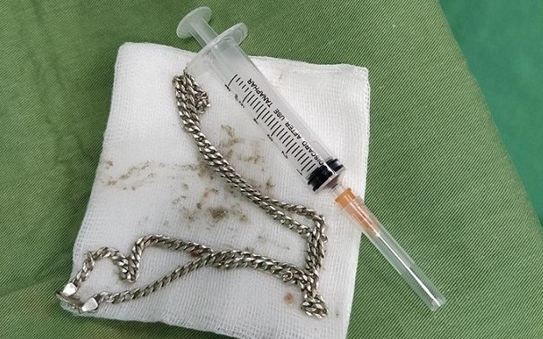 Nghệ An: Bé 29 tháng tuổi nuốt cả sợi dây chuyền bạc vào ruột