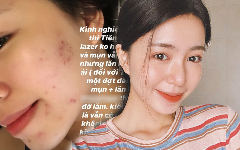 Trước khi da đẹp mĩ mãn, Mẫn Tiên cũng từng khủng hoảng vì mụn ẩn, "bon chen" bắn laser nhưng kết quả vẫn bằng 0