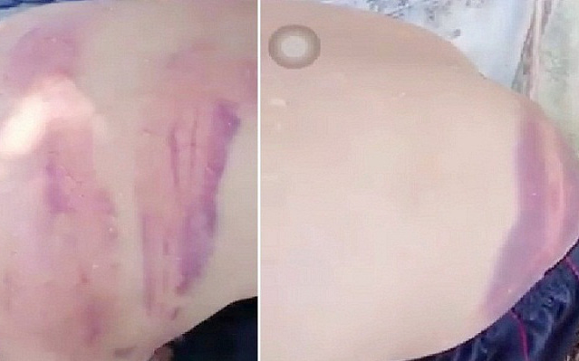 Xác minh vụ người đàn ông bầm tím khắp lưng nghi bị "vợ hờ" đánh ở Nghệ An