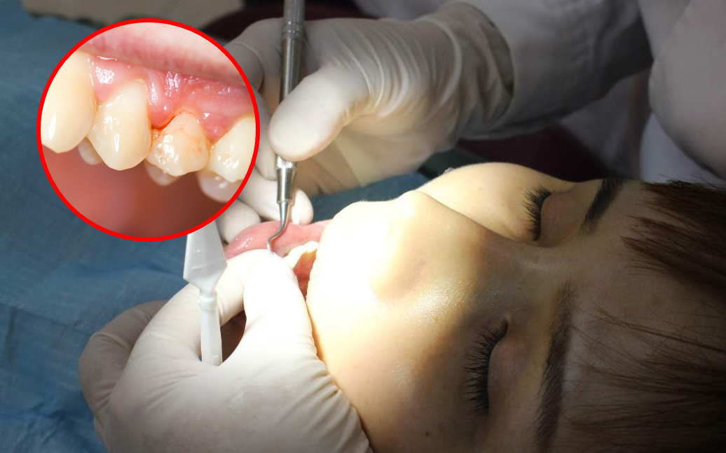 Thường xuyên bị chảy máu khi đánh răng, cô gái 26 tuổi bị viêm nha chu nặng, phải 