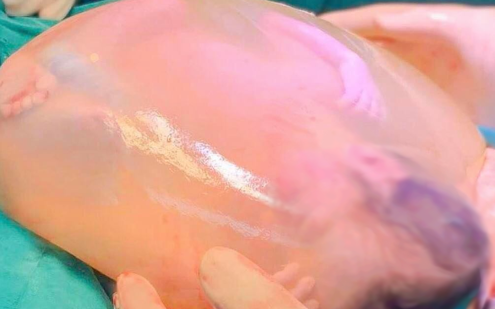 Một trong 2 bé song sinh chào đời còn nguyên trong bọc ối