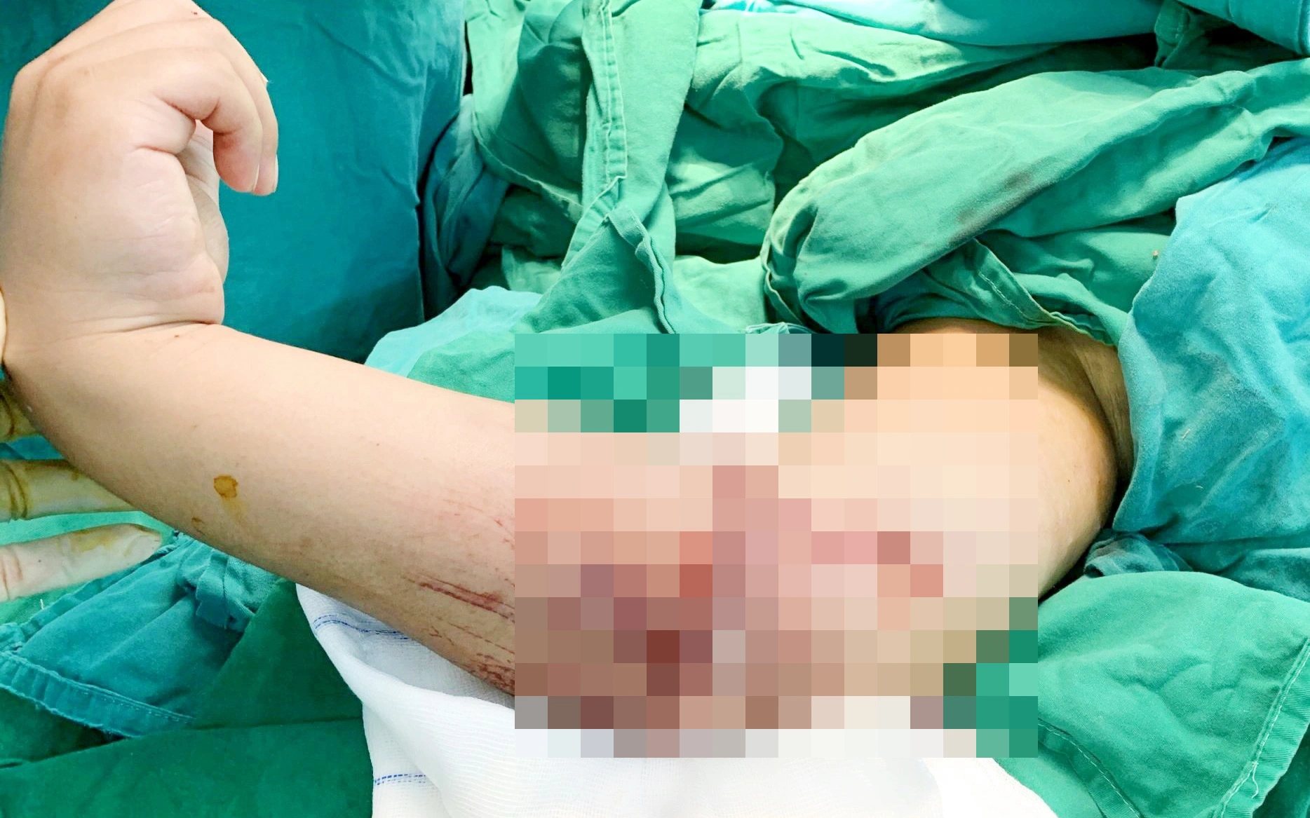 Bé trai 8 tuổi bị đứt lìa cánh tay phải, gia đình hoảng loạn bỏ vào thùng lạnh đưa con đến bệnh viện cấp cứu