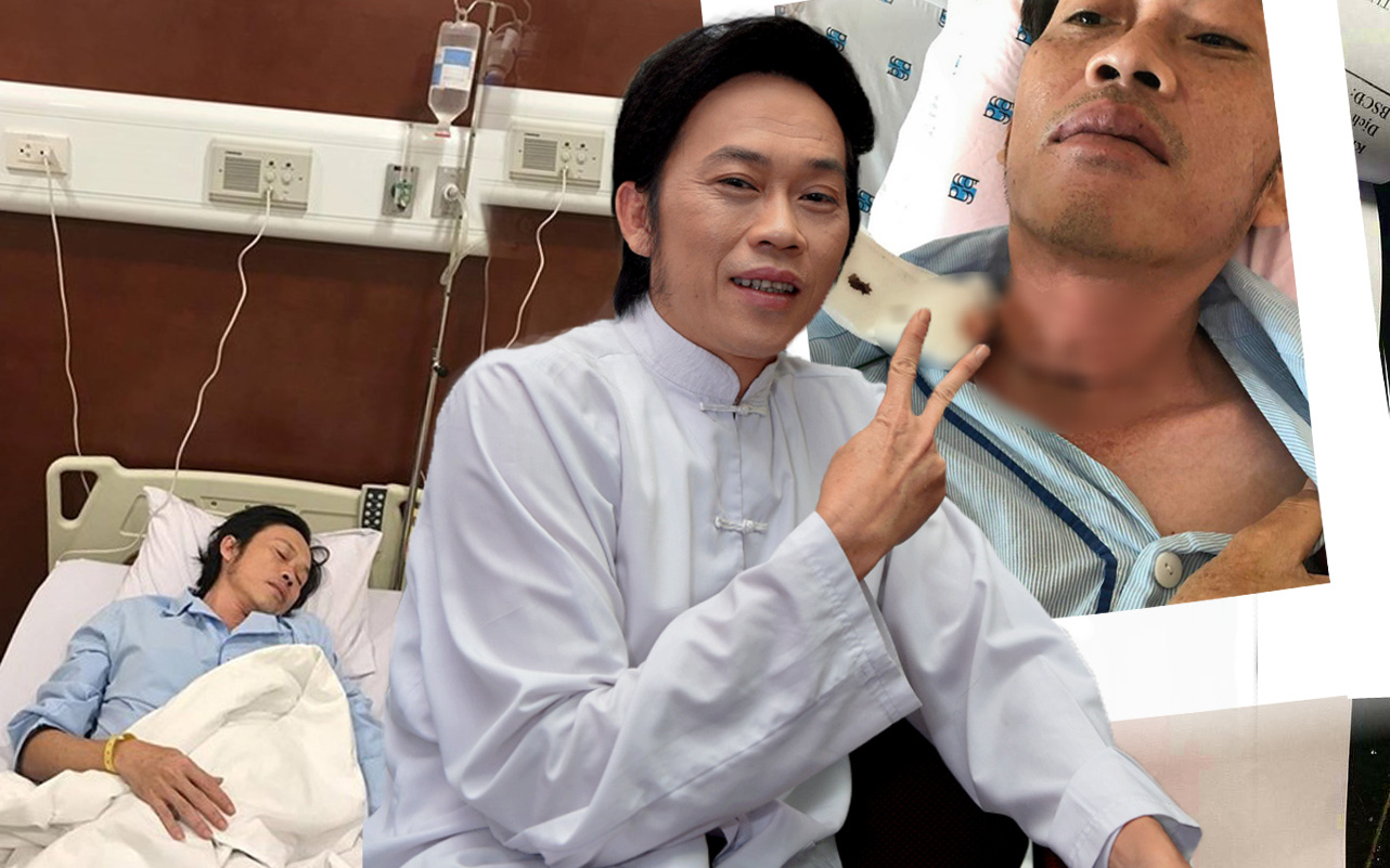 Bác sĩ: Hoài Linh bắt đầu xạ trị vào tháng 10, khả năng là phẫu thuật từ tháng 9 vì mổ xong sau 3-4 tuần mới bắt đầu điều trị