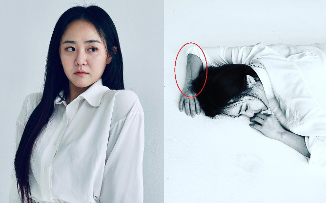 &quot;Em gái quốc dân&quot; Moon Geun Young lộ diện sau 4 cuộc phẫu thuật, xót xa vết thương kéo dài cả nửa cánh tay