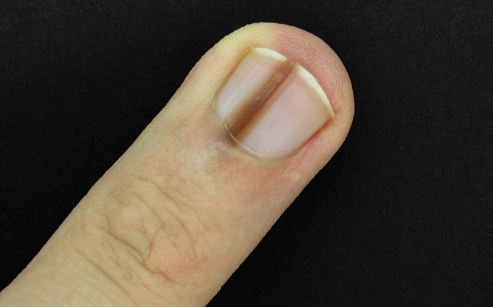 4 biểu hiện bất thường ở ngón tay giữa ngầm cảnh báo gan đang bị tổn thương, mong rằng bạn không gặp bất kỳ điều nào