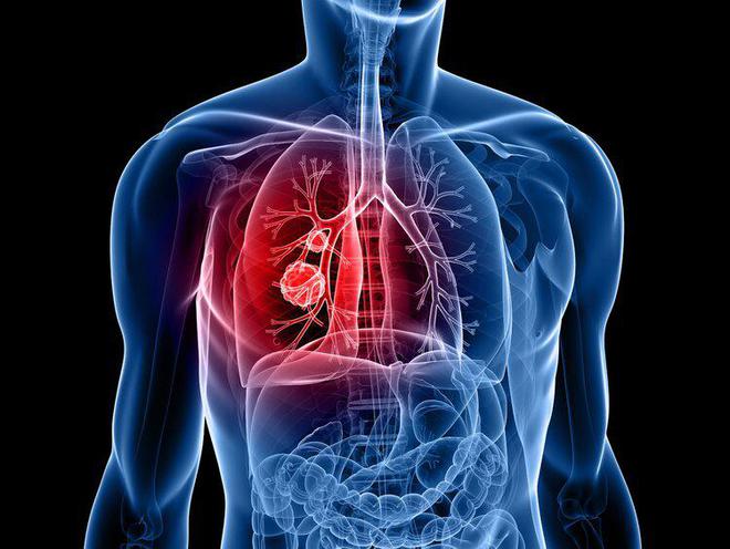 4 dấu hiệu ít ai để ý nhưng lại là dấu hiệu cảnh báo ung thư phổi đang đến gần  - Ảnh 1.