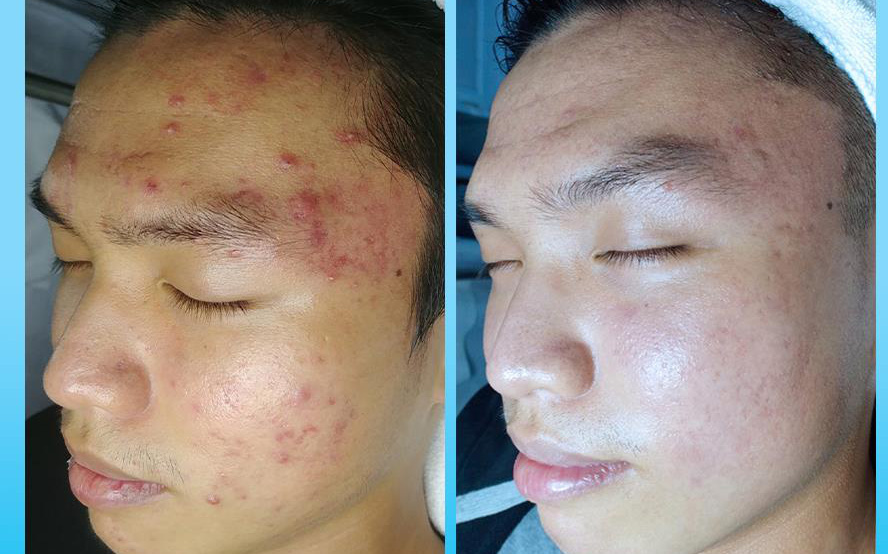 Bị mụn 5 năm không bớt - Bất ngờ hiệu quả sau 3 tuần điều trị tại O2 SKIN