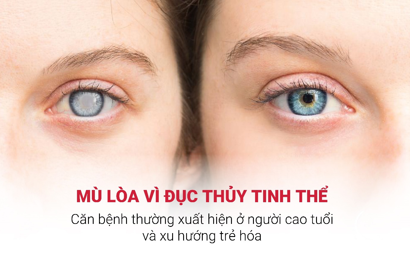 Mù lòa vì đục thủy tinh thể - Căn bệnh thường xuất hiện ở người cao tuổi và xu hướng trẻ hóa