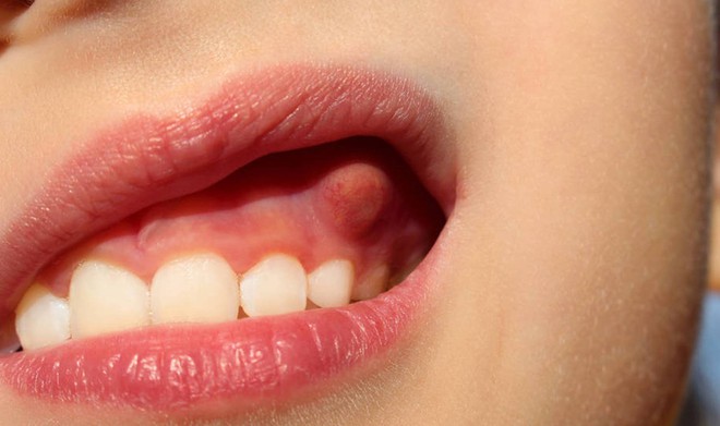 4 bất thường xuất hiện trong khoang miệng đang cảnh báo bệnh viêm nha chu, răng rụng ra mới phát hiện thì đã quá muộn - Ảnh 1.