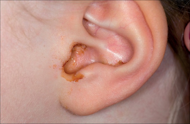 Tiềm ẩn nguy cơ viêm tai giữa ở trẻ do rửa mũi không đúng cách - Ảnh 1.