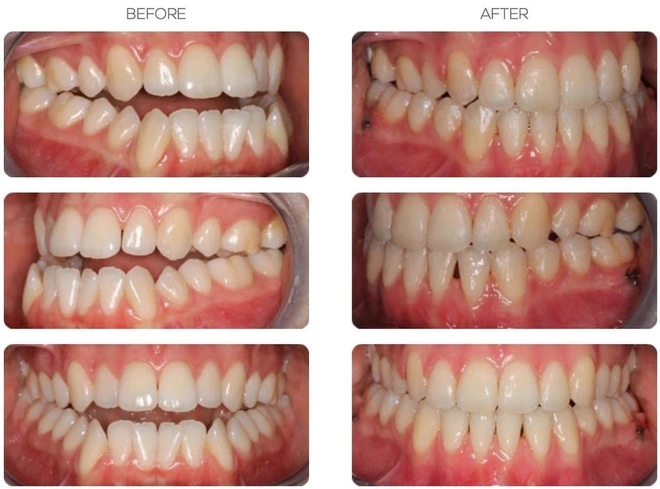 Chuyên gia chỉ ra 6 trường hợp cần niềng răng và tầm quan trọng của việc lựa chọn phương pháp phù hợp - Ảnh 2.