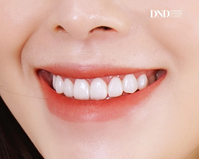 Quy trình dán sứ veneer: Đơn giản và ít phải mài hơn làm răng sứ - Ảnh 4.