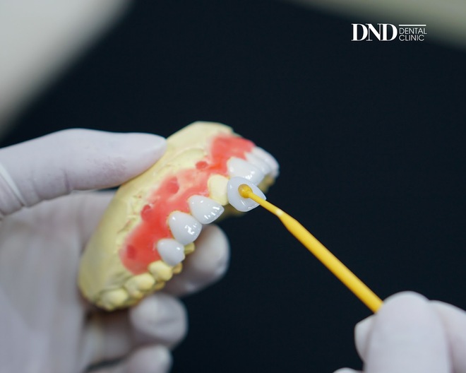 Quy trình dán sứ veneer: Đơn giản và ít phải mài hơn làm răng sứ - Ảnh 3.