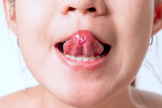 5 điều lưỡi có thể tiết lộ về sức khỏe - từ ung thư đến nguy cơ đột quỵ cũng có thể hiện ra - Ảnh 2.